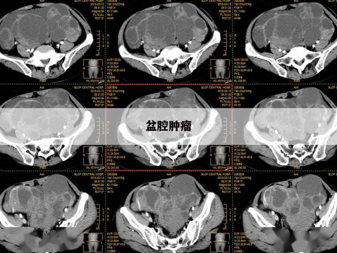 盆腔肿瘤